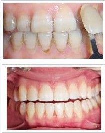 四環素牙 四環素牙