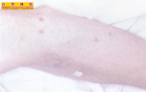 慢性心功能不全