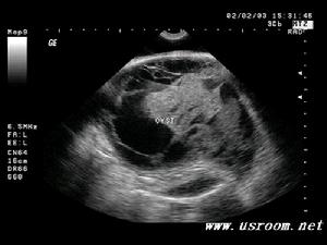 心包內惡性畸胎瘤