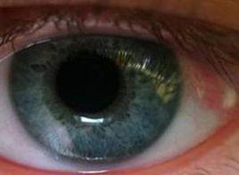 眼白出現紅點 眼白出現紅點