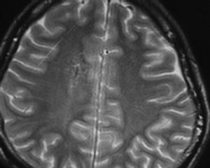 腦靜脈畸形 腦靜脈畸形