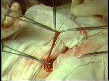 藥物套用於血栓性靜脈炎