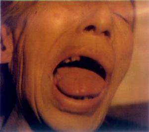 癌性疼痛 癌性疼痛