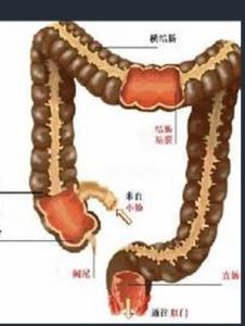 慢性直腸炎 慢性直腸炎