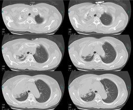 中央型肺癌 中央型肺癌