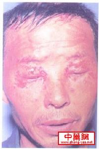 自身致敏性皮炎