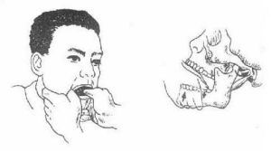 顳下頜關節脫位