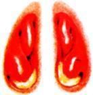 急性化膿性鼻竇炎 急性化膿性鼻竇炎