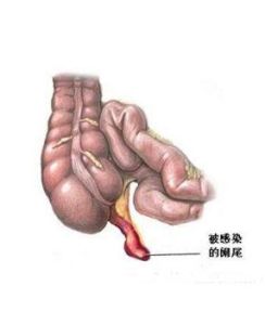 闌尾周圍膿腫 闌尾周圍膿腫