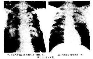肺泡微結石症