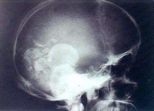 腦型肺吸蟲病 腦型肺吸蟲病