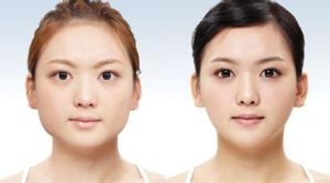 正頜手術 正頜手術