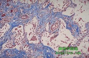 肺嗜酸細胞組織細胞增生症