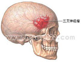 三叉神經瘤 三叉神經瘤