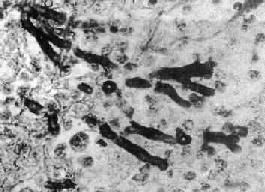 毛黴菌病 毛黴菌病