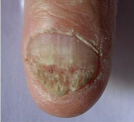 慢性甲溝炎型灰指甲