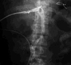 慢性內照射放射病 慢性內照射放射病