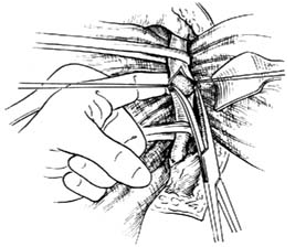 圖6:取出結石(示意圖)