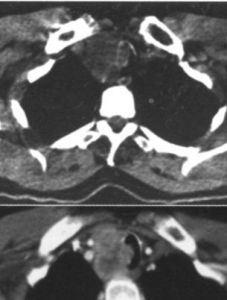 神經內分泌腫瘤 神經內分泌腫瘤