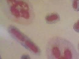 細菌協同性壞疽 細菌協同性壞疽