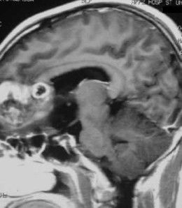 神經膠質瘤 神經膠質瘤