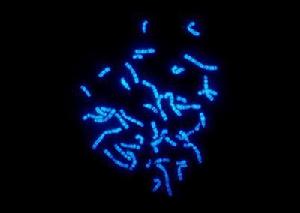 染色體異常伴發的精神障礙