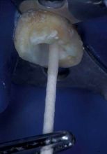 紙尖吸去多餘粘接劑