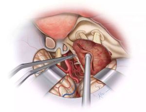頸內動脈海綿竇瘺 