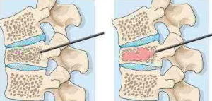 經皮椎體成形術