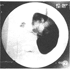 急性腎小球腎炎