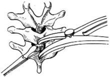 示意圖1:擴張椎板間隙，切除中央黃韌帶