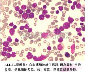 急性淋巴細胞白血病