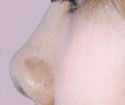 自體軟骨隆鼻術 自體軟骨隆鼻術