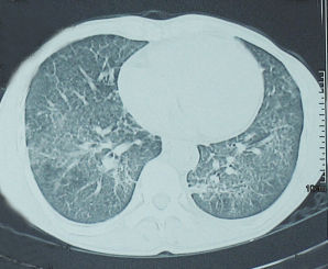 肺泡表面活性物質