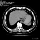 中腹部平掃 中腹部平掃