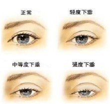 上眼皮下垂