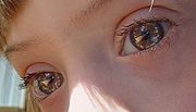 唐氏綜合徵患者的瞳孔上會有典型的白點，叫Brushfield斑點
