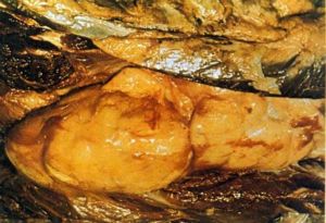 （圖）脂肪肉瘤