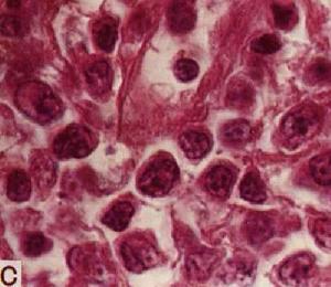 何杰金氏淋巴瘤