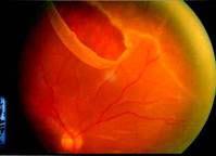 視網膜裂孔 視網膜裂孔