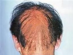 念珠狀發 念珠狀發