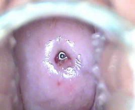 宮頸囊腫症 宮頸囊腫症