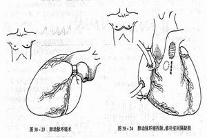 左室流出道阻塞 左室流出道阻塞