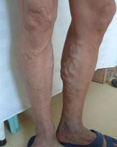 小腿靜脈曲張 小腿靜脈曲張