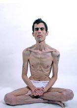 交替性暴食厭食症