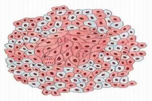 異位內分泌綜合徵 異位內分泌綜合徵