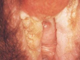 原發性外陰癌 原發性外陰癌