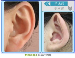 招風耳矯正