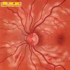 血管性視網膜病變
