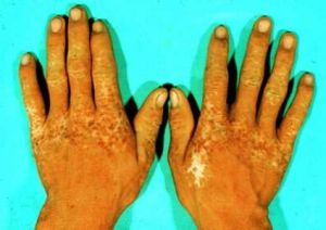 土肥對稱性肢端色素沉著症 土肥對稱性肢端色素沉著症